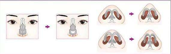 鼻頭縮小術(shù)整形是怎樣的