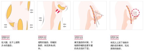 廣州自體脂肪豐胸效果好不好呢