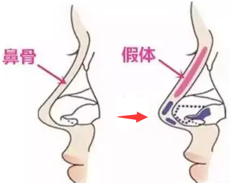 深圳假體隆鼻后要多久才能消腫