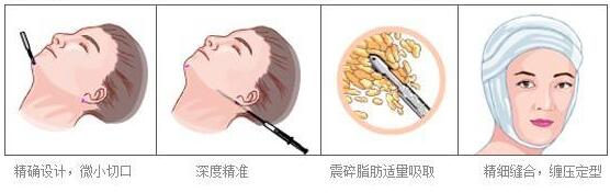 面部吸脂術(shù)后臉部出現(xiàn)的硬塊怎么消除呢