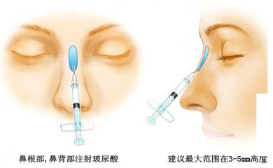 廣州哪個機構(gòu)隆鼻比較好呢