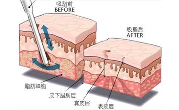 廣州做抽脂減肥有沒(méi)有什么風(fēng)險(xiǎn)