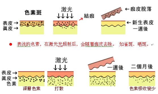 去色斑需要多少錢