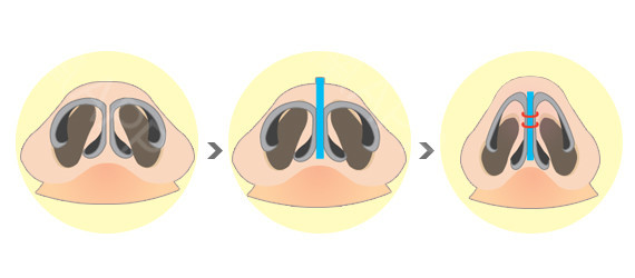 泉州鼻孔縮小手術(shù)需要多少錢