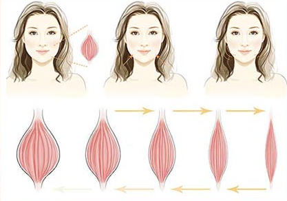 瘦臉注射后多久見效
