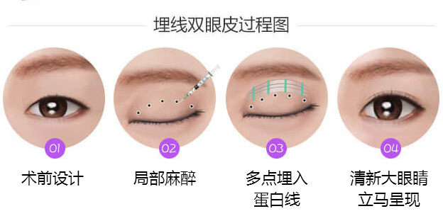 衡陽(yáng)哪里做埋線雙眼皮比較好