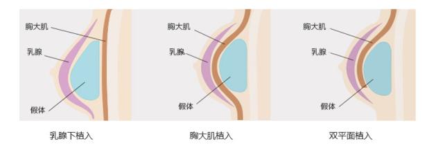 自體脂肪隆胸