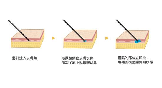 打玻尿酸除皺