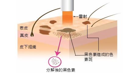 激光祛雀斑