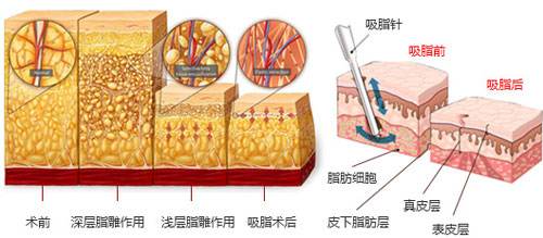 沈陽做抽脂減肥術(shù)后有哪些護理工作