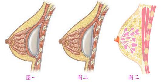 武漢做假體隆胸手術(shù)后是否能保持終生