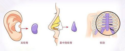 武漢肋軟骨隆鼻價(jià)格