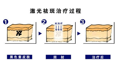 激光祛斑的價格