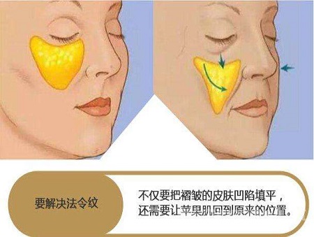 脂肪填充法令紋能維持多少時間？