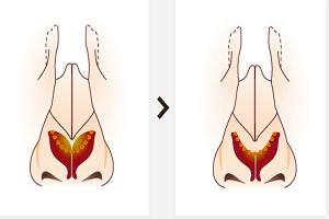 自體軟骨組織隆鼻有哪些優(yōu)點？