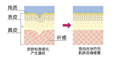 激光除皺