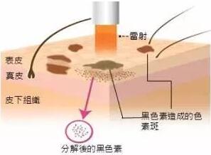 激光祛斑