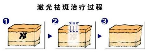 激光祛斑