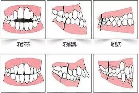 牙齒矯正的優(yōu)點是什么