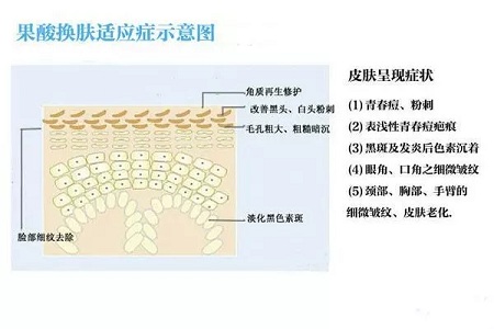 擠痘竟然被送進(jìn)ICU！你的痘痘還好嗎？