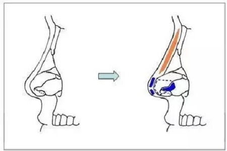 擔(dān)心鼻整形假體透光、發(fā)紅、移位？了解下自體軟骨