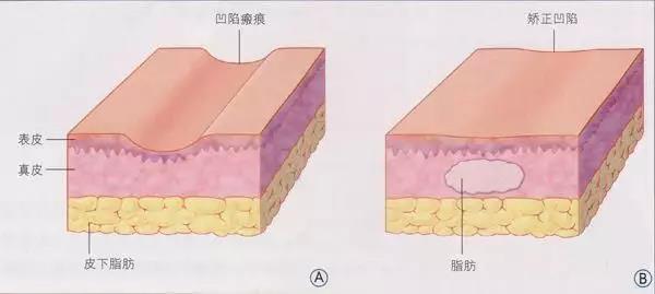 自體脂肪填充為什么需要二次補(bǔ)打？