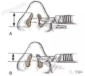 隆鼻手術(shù)切口在哪里？才能自然不留疤