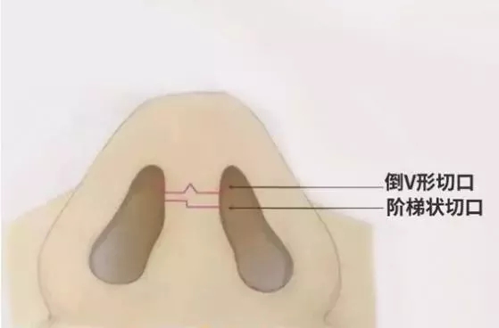 隆鼻手術(shù)切口在哪里？才能自然不留疤