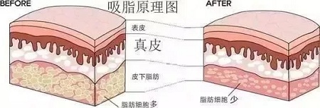 醫(yī)美白皮書：吸脂等于減肥嗎？