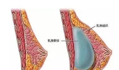 自體脂肪or假體隆胸，我到底應(yīng)該怎么選？