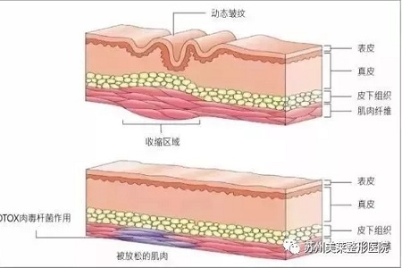 你無法用玻尿酸除掉所有皺紋！