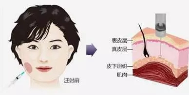 瘦臉會(huì)導(dǎo)致臉部凹陷松弛？