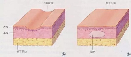 明星的臉和你的臉差的只是這一步！--面部脂肪填充