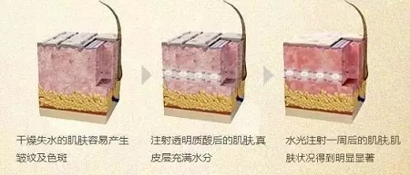 水光，打1次和4次究竟有多大區(qū)別？