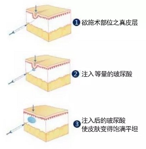 用玻尿酸治療鼻唇溝，一定要注意這種情況！