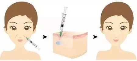 用玻尿酸治療鼻唇溝，一定要注意這種情況！