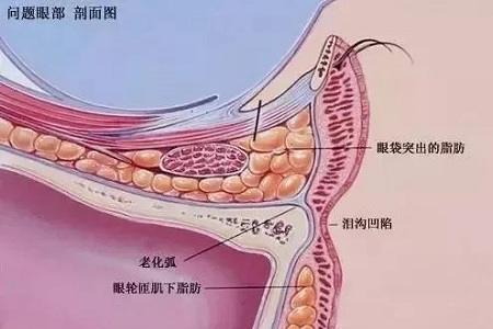 眼袋淚溝怎樣同時(shí)祛除