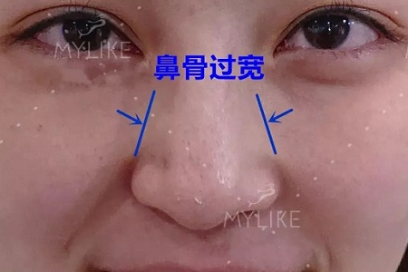 側(cè)面看鼻梁不矮,正面看鼻子卻很塌是什么原因？