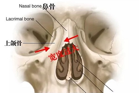 側(cè)面看鼻梁不矮,正面看鼻子卻很塌是什么原因？