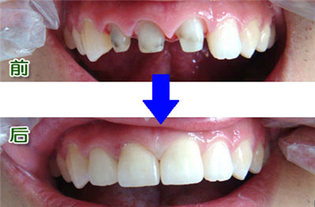 烤瓷牙和全瓷牙有什么區(qū)別