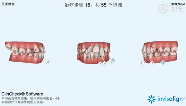 南京美萊口腔全景側(cè)位片，拍照取模，動畫方案設(shè)計