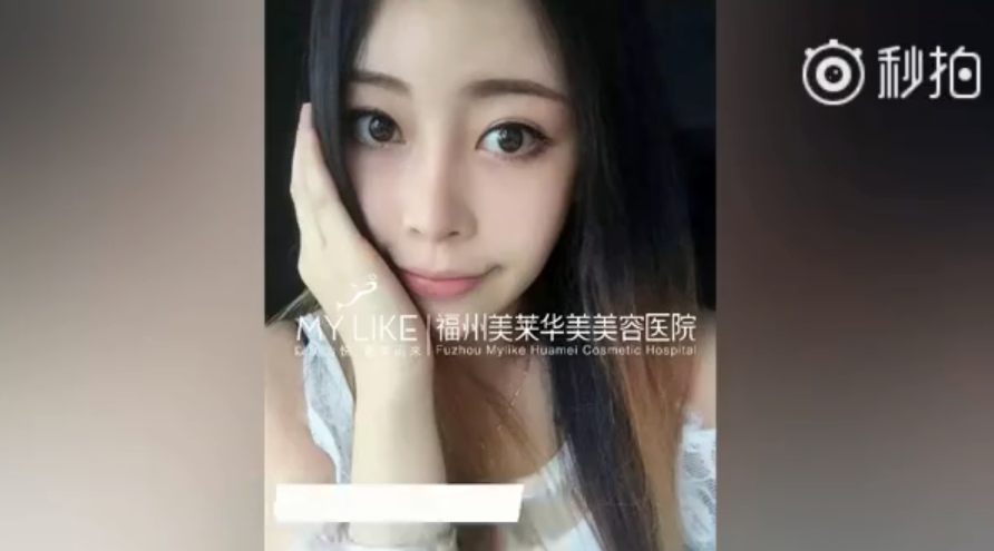 福州美萊鼻子幾毫米的改變，自信百倍的蛻變