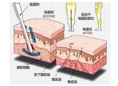 鄭州美萊吸脂瘦身等于減重？