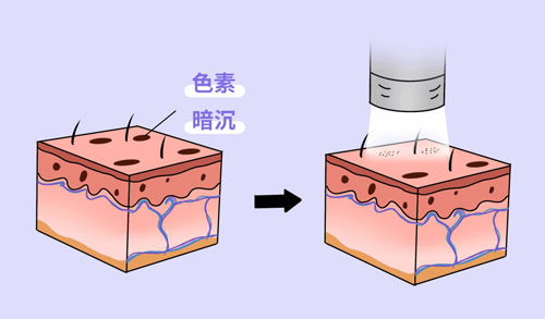 想要嫩膚，應(yīng)該選擇做光電還是水光